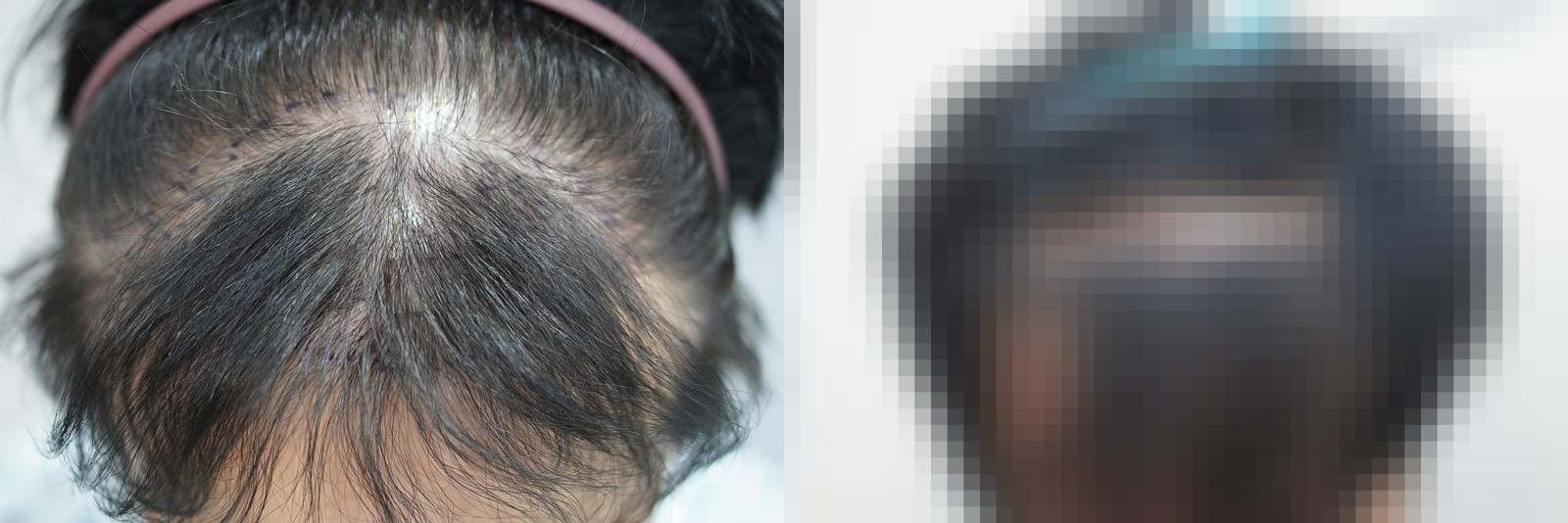 시술 전과 수술 1년 후 모발 상태 비교