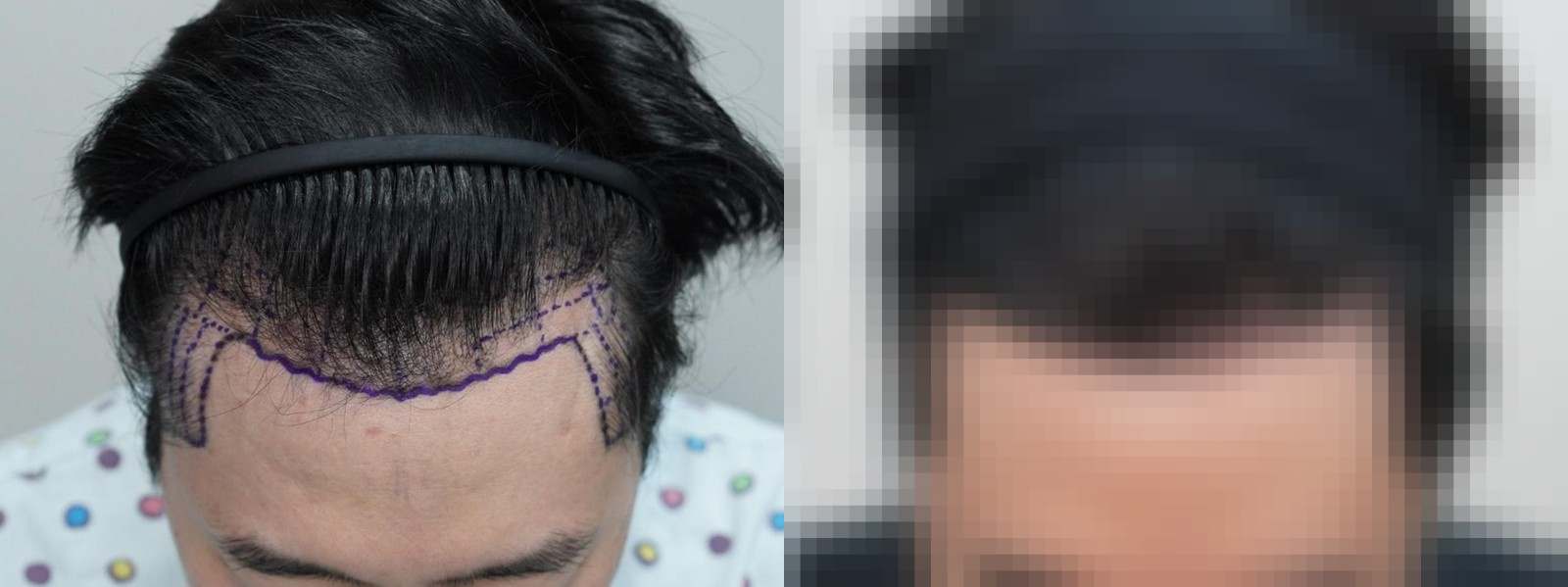 시술 전과 수술 1년 후 모발 상태 비교