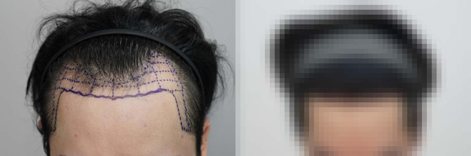 시술 전과 수술 1년 후 모발 상태 비교
