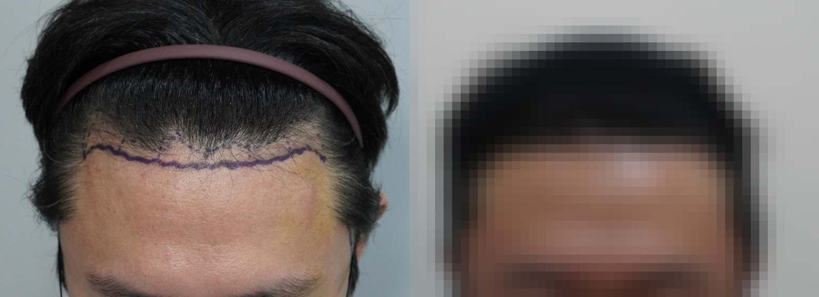시술 전과 수술 1년 후 모발 상태 비교