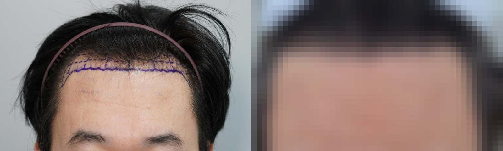 시술 전과 수술 1년 후 모발 상태 비교