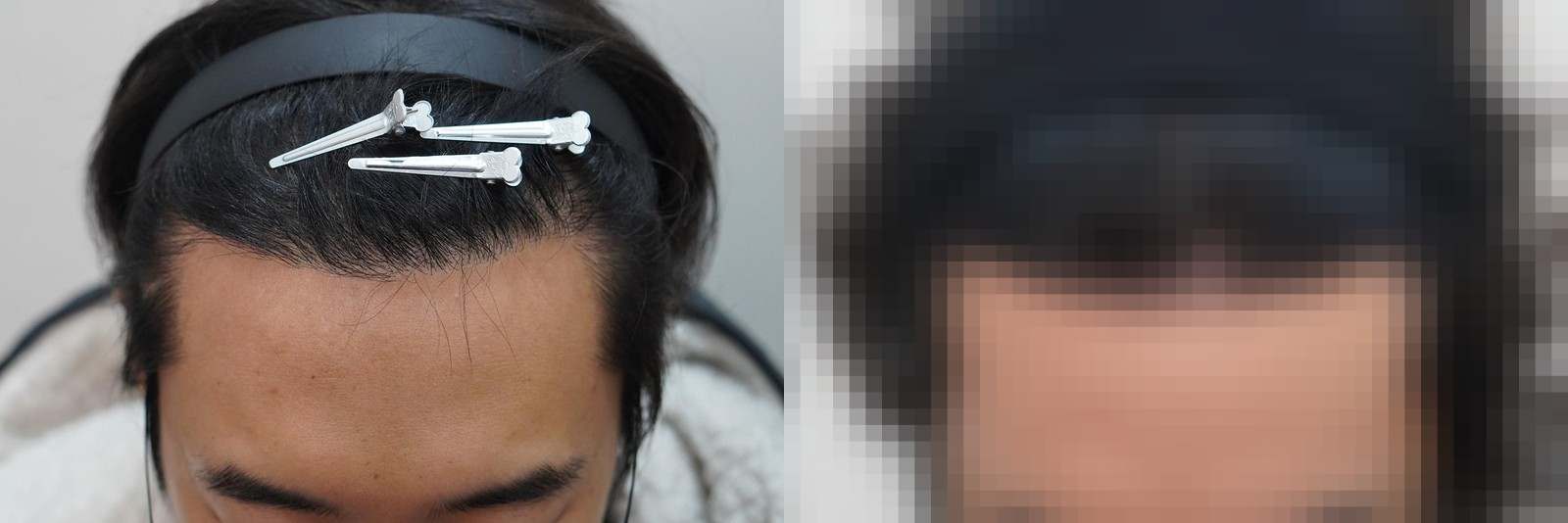 시술 전과 수술 1년 후 모발 상태 비교