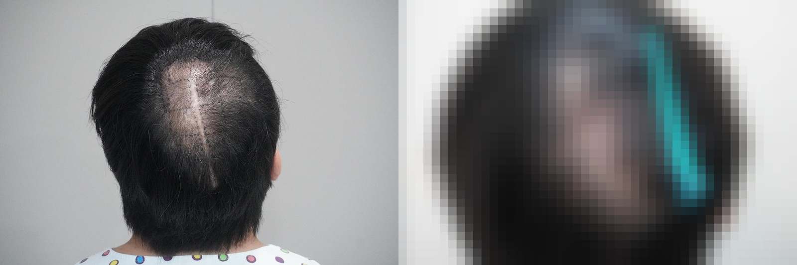 시술 전과 수술 1년 후 모발 상태 비교