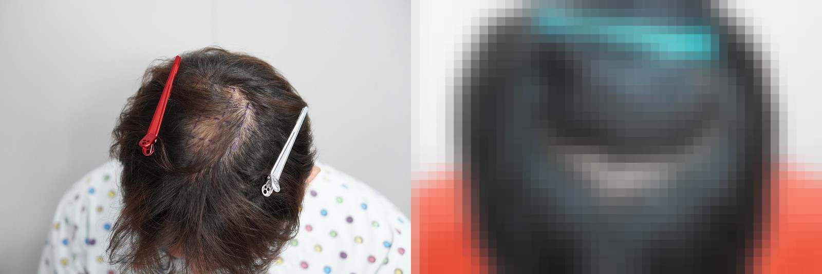 시술 전과 수술 1년 후 모발 상태 비교