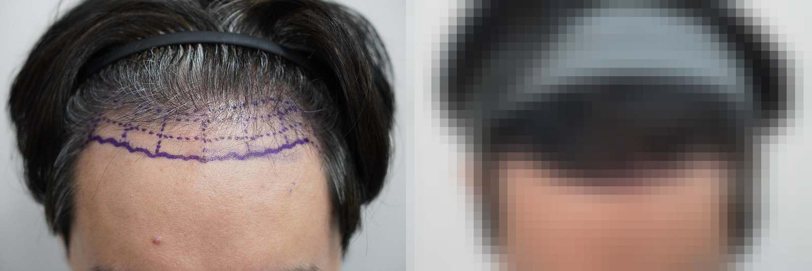 시술 전과 수술 1년 후 모발 상태 비교