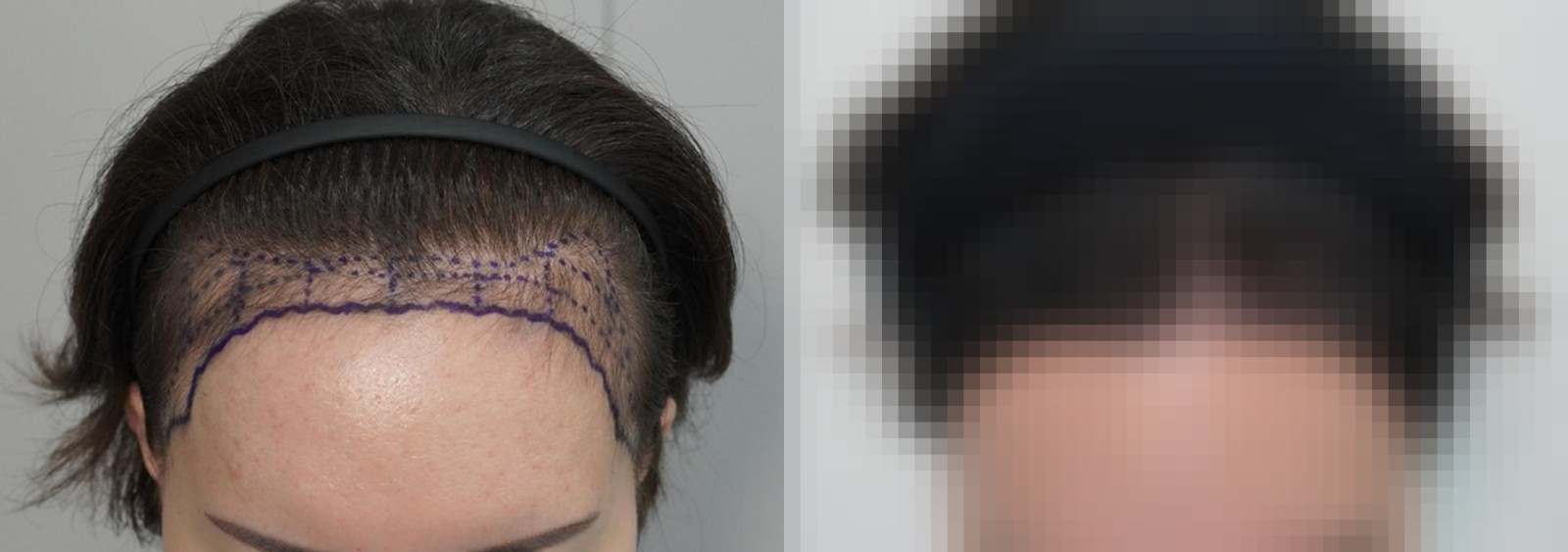 시술 전과 수술 1년 후 모발 상태 비교