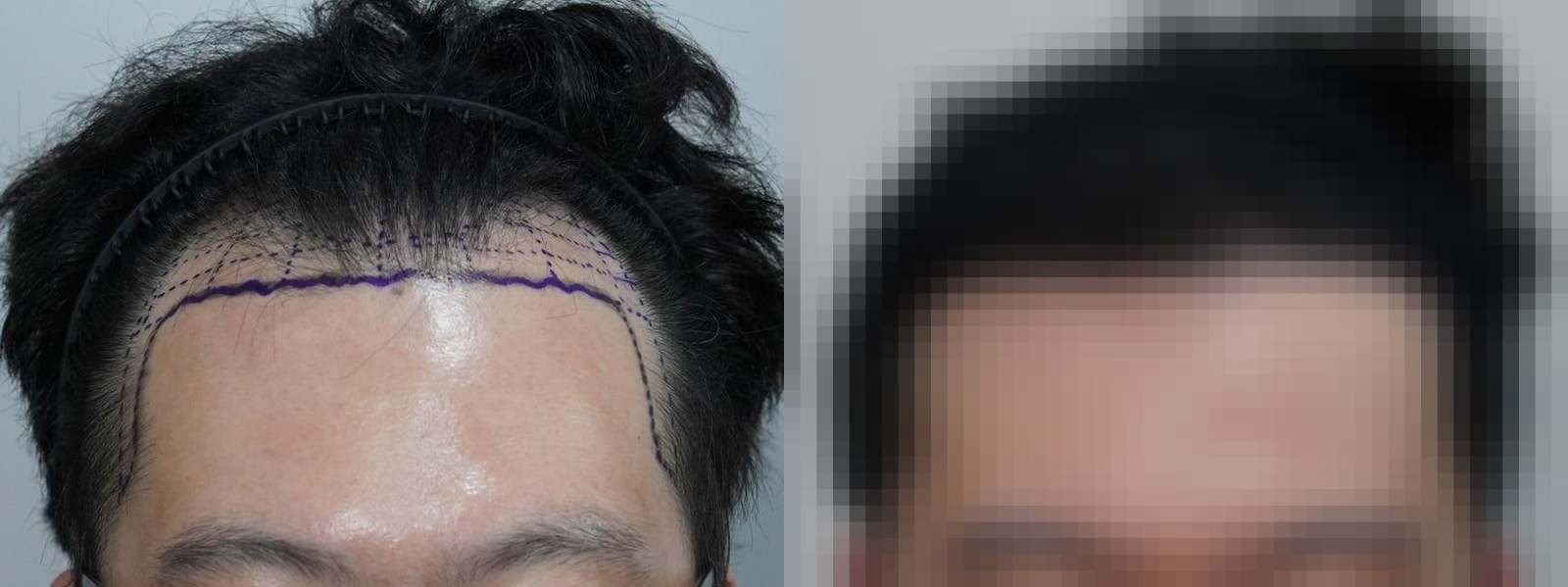 시술 전과 수술 1년 후 모발 상태 비교