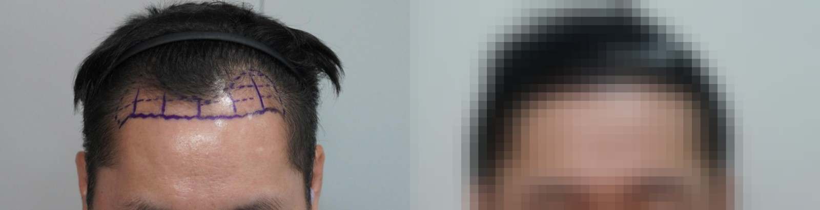 시술 전과 수술 1년 후 모발 상태 비교
