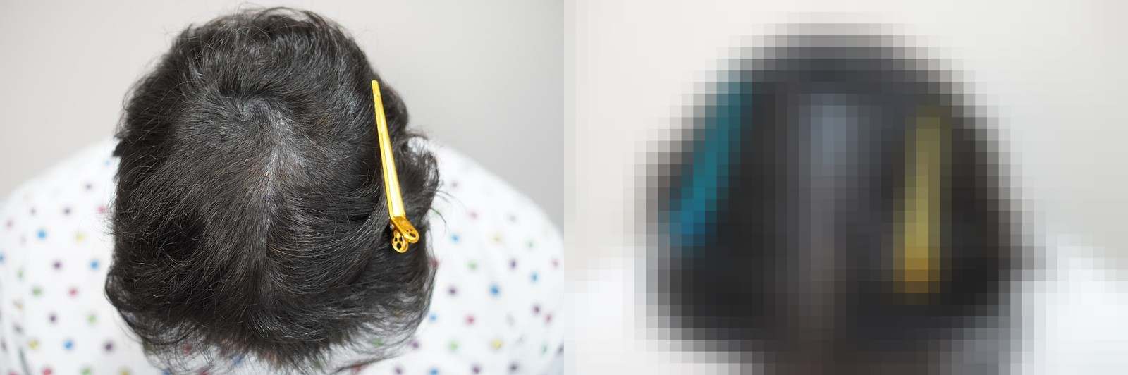 시술 전과 수술 1년 후 모발 상태 비교