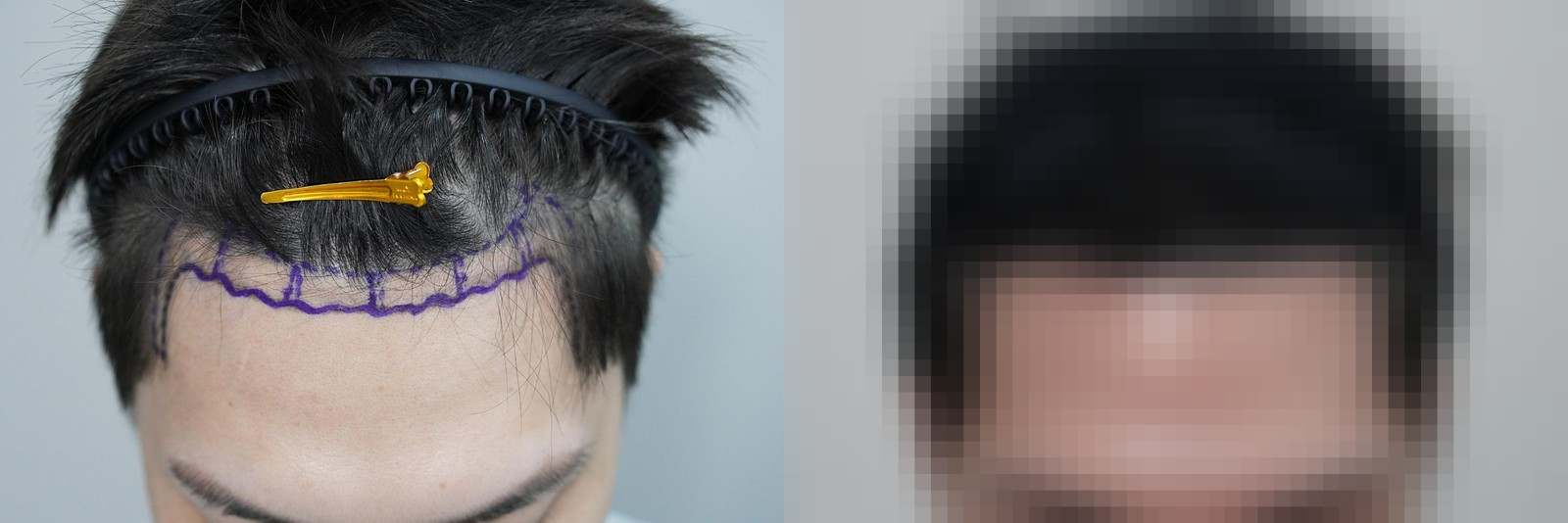 시술 전과 수술 1년 후 모발 상태 비교