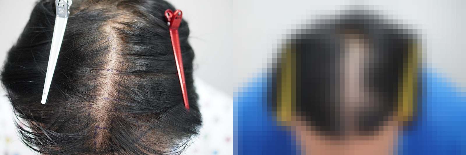 시술 전과 수술 1년 후 모발 상태 비교