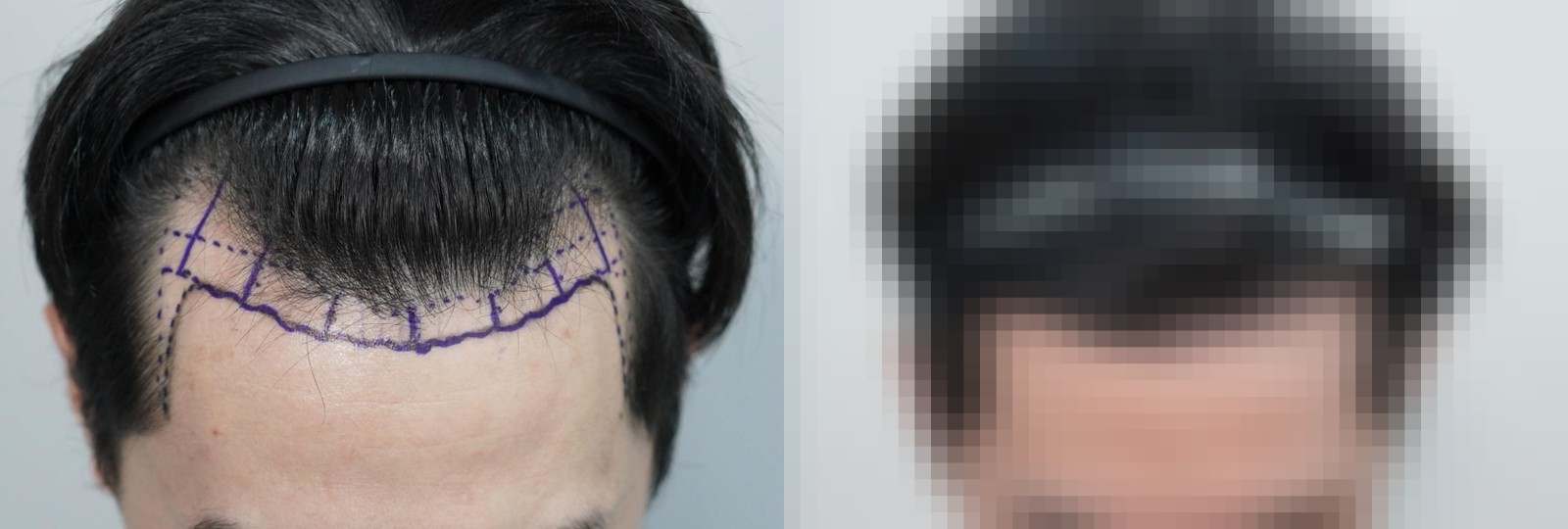 시술 전과 수술 1년 후 모발 상태 비교