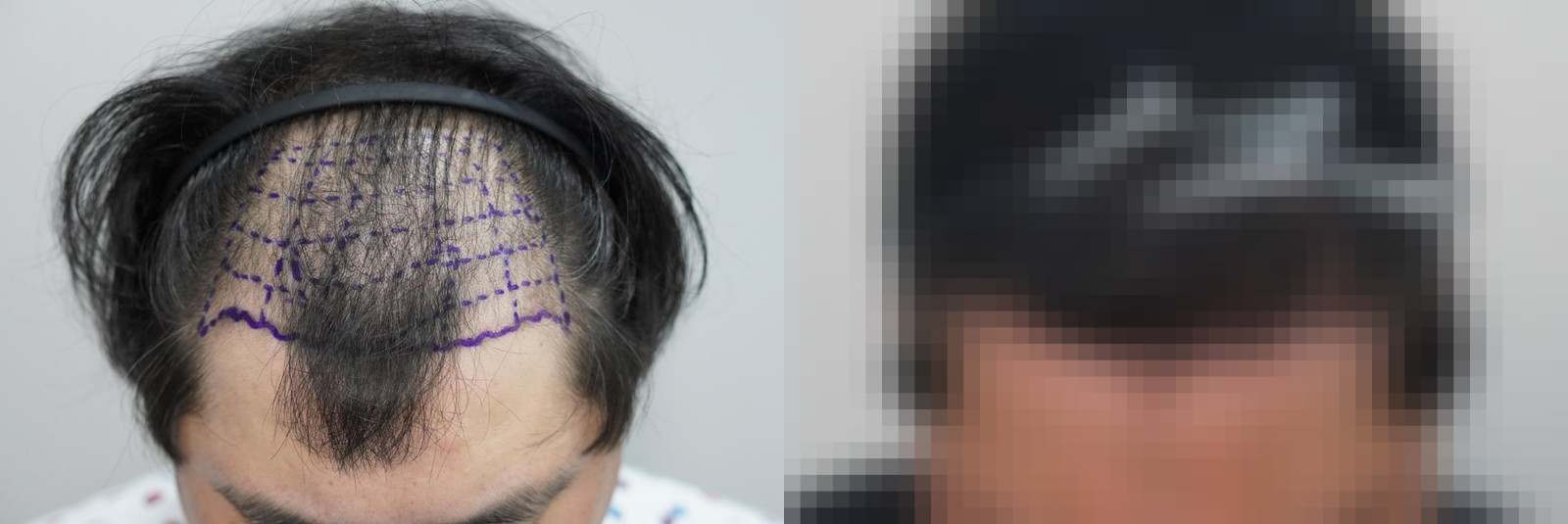 시술 전과 수술 1년 후 모발 상태 비교