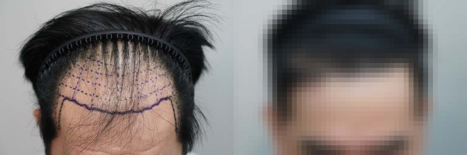 시술 전과 수술 1년 후 모발 상태 비교