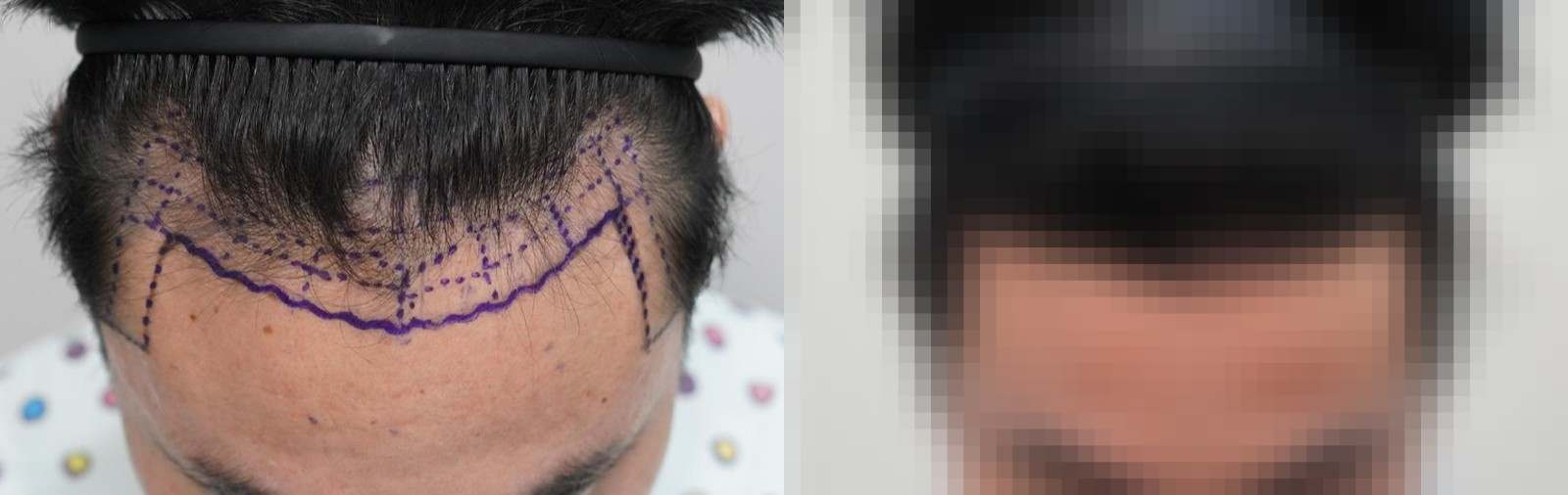 시술 전과 수술 1년 후 모발 상태 비교