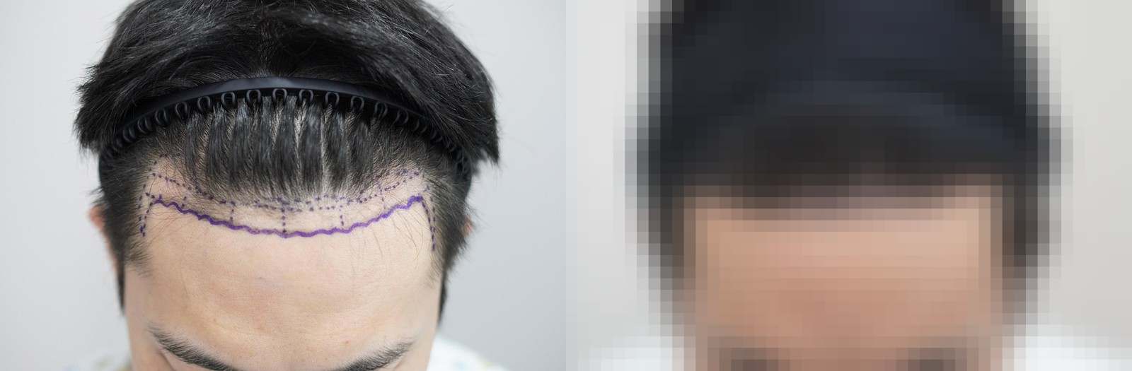 시술 전과 수술 1년 후 모발 상태 비교