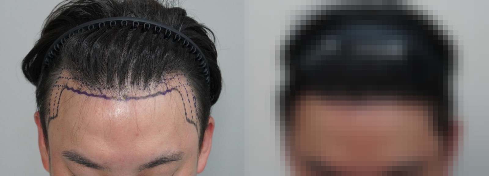 시술 전과 수술 1년 후 모발 상태 비교