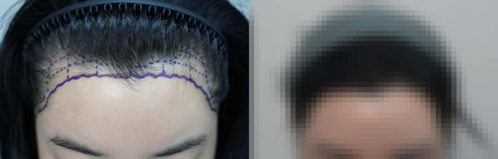 시술 전과 수술 1년 후 모발 상태 비교