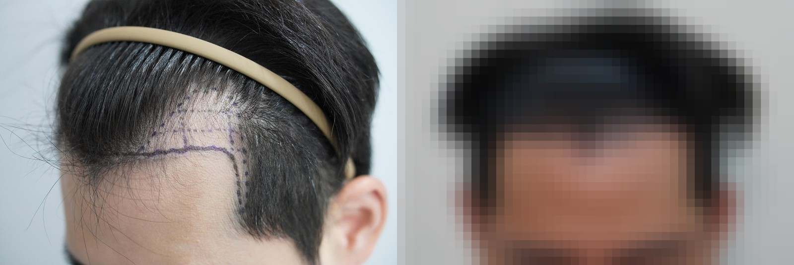 시술 전과 수술 1년 후 모발 상태 비교