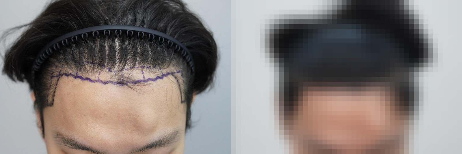 시술 전과 수술 1년 후 모발 상태 비교