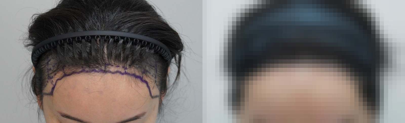 시술 전과 수술 1년 후 모발 상태 비교