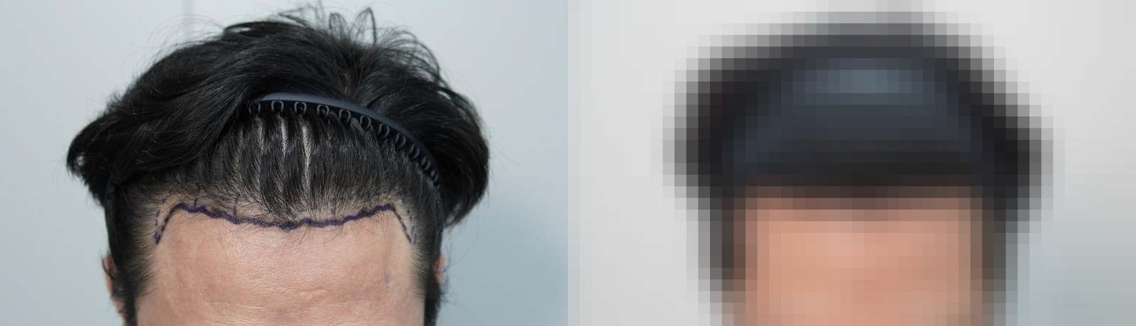 시술 전과 수술 1년 후 모발 상태 비교