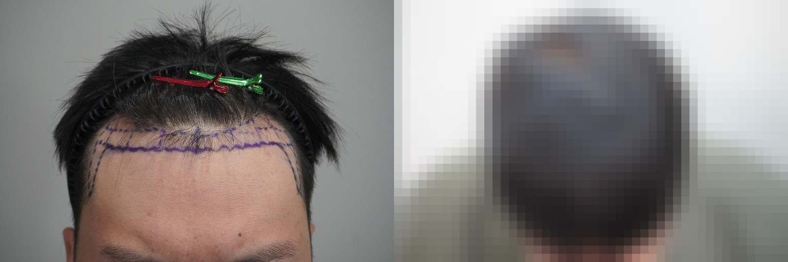 시술 전과 수술 1년 후 모발 상태 비교