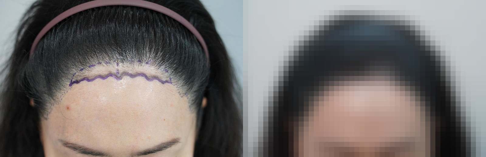 시술 전과 수술 1년 후 모발 상태 비교