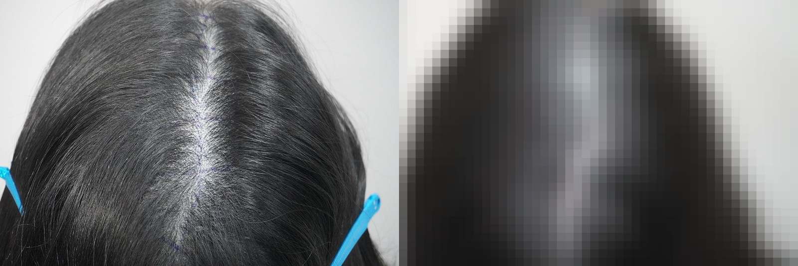 시술 전과 수술 1년 후 모발 상태 비교