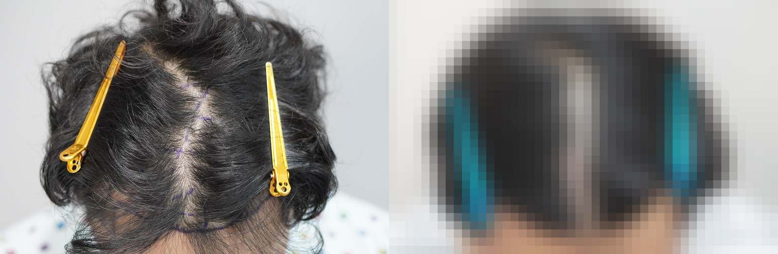 시술 전과 수술 1년 후 모발 상태 비교