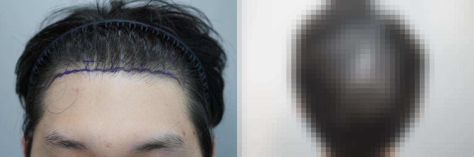 시술 전과 수술 1년 후 모발 상태 비교