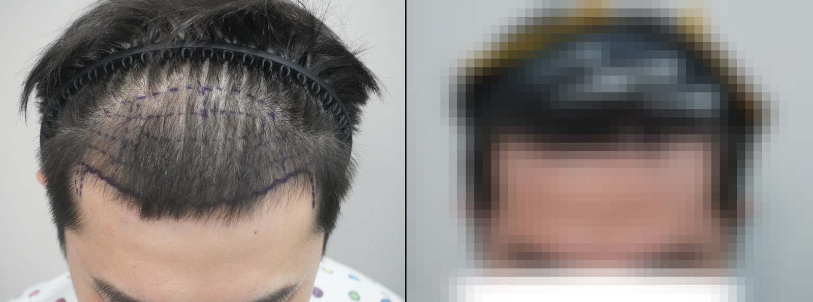 시술 전과 수술 1년 후 모발 상태 비교