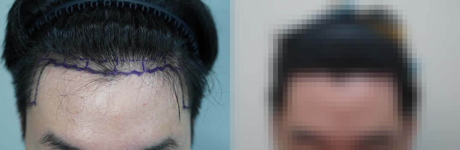 시술 전과 수술 1년 후 모발 상태 비교