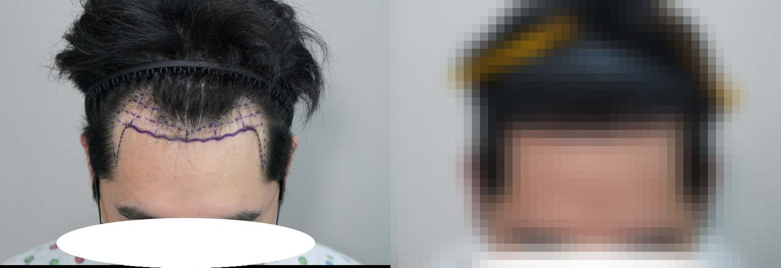 시술 전과 수술 1년 후 모발 상태 비교