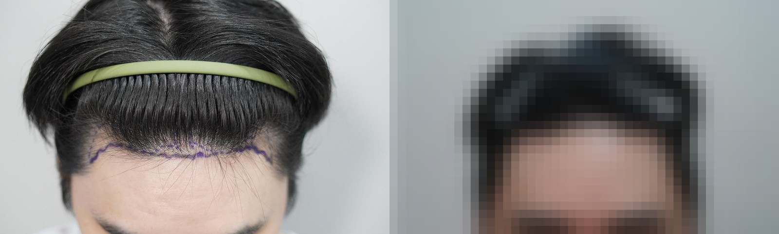 시술 전과 수술 1년 후 모발 상태 비교