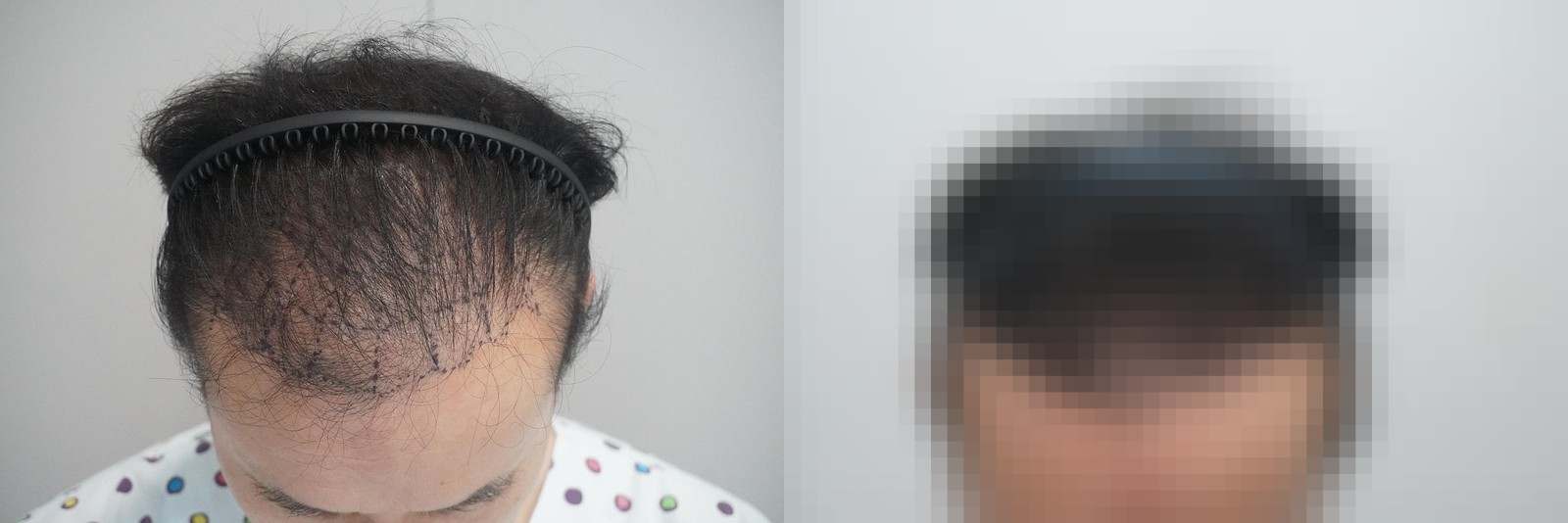 시술 전과 수술 1년 후 모발 상태 비교