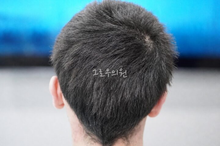 무삭발 비절개 모발이식 수술 전 사진