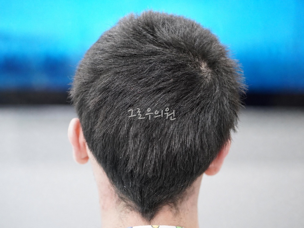무삭발 비절개 모발이식 수술 전 사진