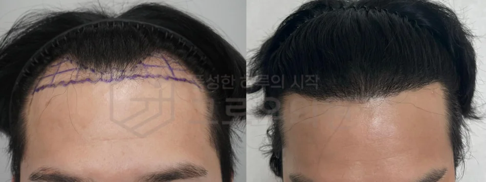 부산모발이식비용 3000모 결과