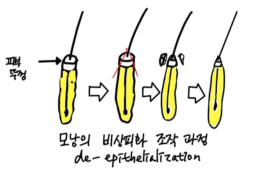 모발이식 개구리알