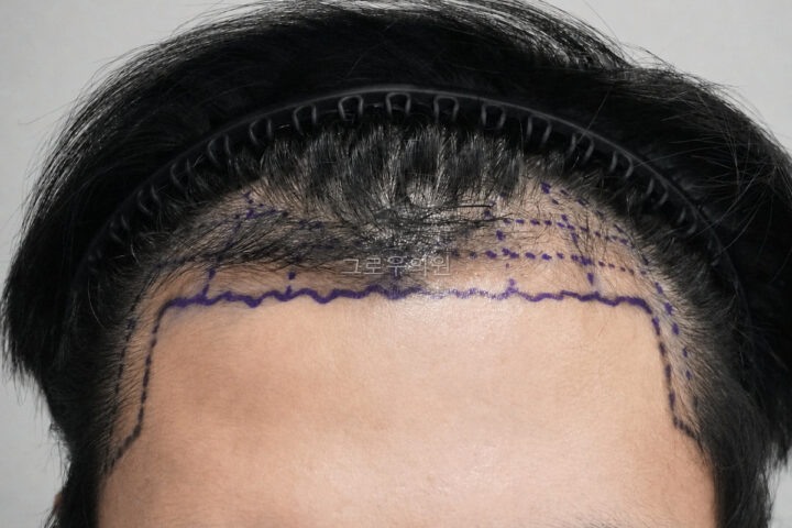 부산 비절개모발이식 수술 전 사진