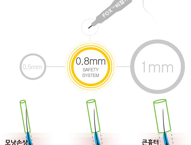 비절개 모발이식에서 모낭을 채취할 때 사용하는 원통형 펀치 팁