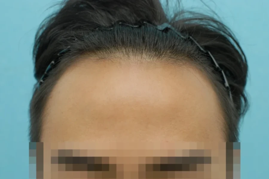 부산모발이식 비절개 전문 그로우의원